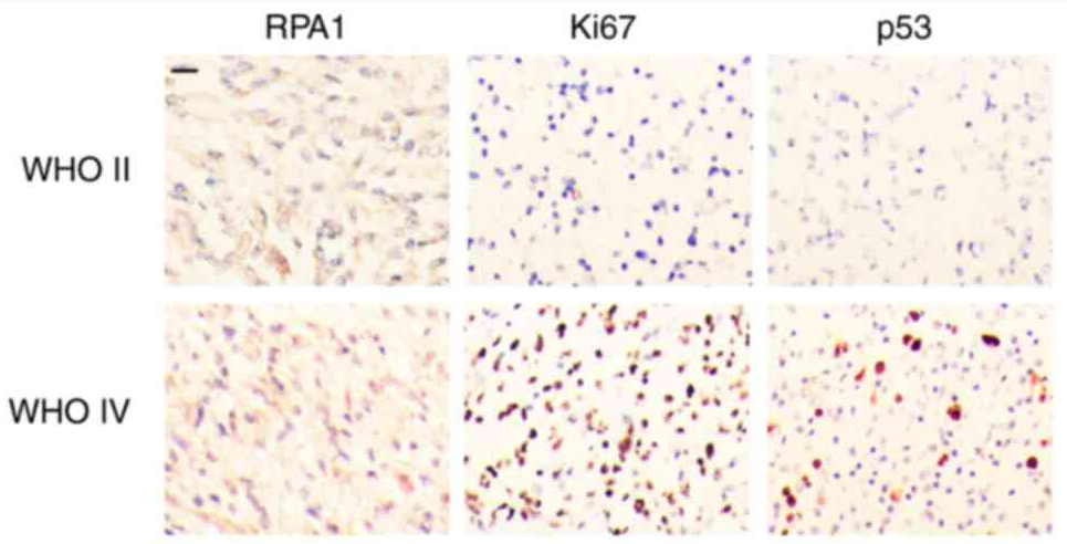p53 Antibody - Figure 4 - Immunohistochemical staining images of RPA1, Ki-67 and p53 in gliomas of different WHO grades.