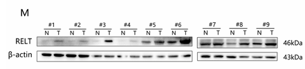 RELT Antibody - FIGURE 1High expression ofRELTin ccRCC predicts poor prognosis (A) Increased or decreased RELT in diferent tumor types from The Cancer GenomeAtlas (TCGA) database were identifed by Tumor lmmunity Estimation Resource (TIMER): (B) Analysis of ccRCC samples from the TCGA database.