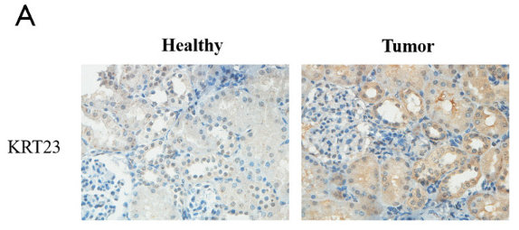 Keratin 23 Antibody - Figure 2 The expression of KRT23 in GC cells.